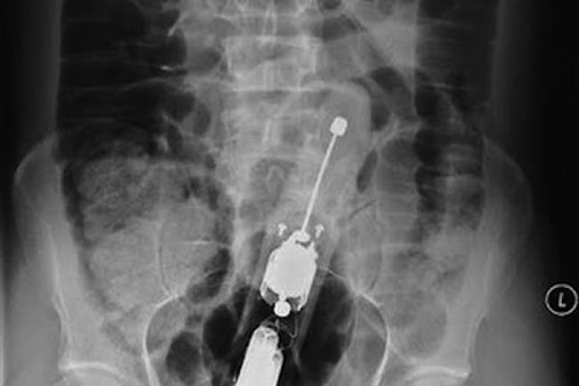 Deep Anal Sex X Ray - X-ray of dildo - Porno photo