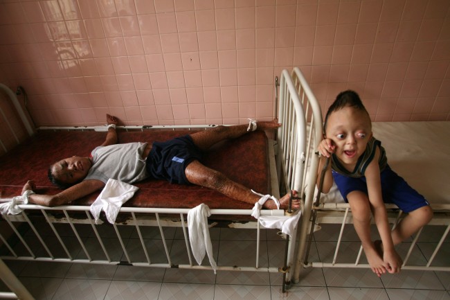 Thirteen-year-old Tran Minh Anh, left, who was born in Long An Province and suffers from a disease called X-linked ichthyosis, is tied down to a bed to protect from hurting himself at the "Peace Village" of Tu Du hospital in Ho Chi Minh City, May 25, 2007. On the right is Nguyen Xuan Minh, age 6. Accoding to hospital staff, both boys are suffering from conditions suspected to have been caused by exposure by their parents to dioxin in the chemical defoliant Agent Orange.