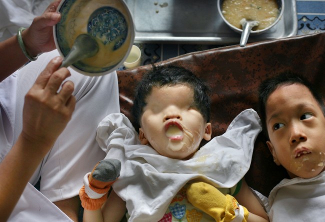 *Five-year-old girl Tran Huynh Thuong Sinh, who was born without eyes in the Binh Dinh province of Vietnam, is fed breakfast by a nurse at the "Peace Village" center at Tu Du hospital in Ho Chi Minh City, Vietnam, in this May 25, 2007, file photo. Officials at the hospital suspect that the dioxin in Agent Orange blocks the receptors in a developing fetus, preventing the hormones that would normally instruct the cells to form eyes from doing so. 